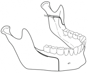 osteotomie-sagittale-de-la-branche-montante-mandibulaire-1-chirurgie-orthognatique-docteur-bontemps